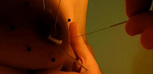 Play piercing with acupuncture needles 1
